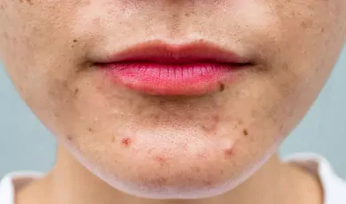 Aknenin nedenleri ve semptomları hafifletmeye yardımcı olabilecek bazı tedavi seçenekleri