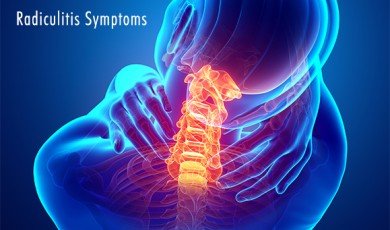 Radiküliti Anlamak: Nedenleri, Belirtileri ve Tedavi Seçenekleri