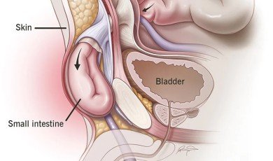 Kasık Fıtığı: Belirtiler, Teşhis ve Tedavi Seçenekleri