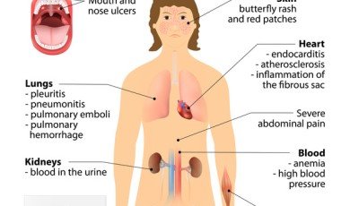 Lupus'un Gizemlerini Açığa Çıkarmak: Görünmez Bir Hastalığı Anlamak